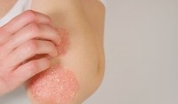 CBD para la psoriasis