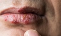 CBD para herpes